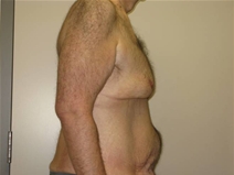 Male Breast Reduction Before Photo by Neal Goldberg, MD; Scarsdale, NY - Case 21966