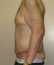 Tummy Tuck After Photo by Neal Goldberg, MD; Scarsdale, NY - Case 21967
