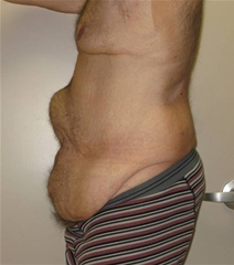 Tummy Tuck Before Photo by Neal Goldberg, MD; Scarsdale, NY - Case 21967