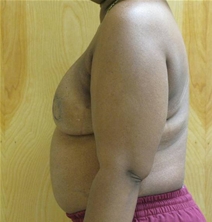 Breast Reconstruction After Photo by Neal Goldberg, MD; Scarsdale, NY - Case 21980