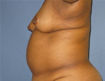 Breast Reconstruction Before Photo by Neal Goldberg, MD; Scarsdale, NY - Case 21980