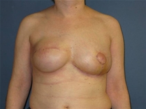 Breast Reconstruction After Photo by Neal Goldberg, MD; Scarsdale, NY - Case 21981