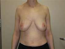 Breast Reconstruction Before Photo by Neal Goldberg, MD; Scarsdale, NY - Case 21981