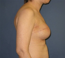 Breast Reconstruction After Photo by Neal Goldberg, MD; Scarsdale, NY - Case 21981