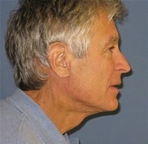 Facelift After Photo by Neal Goldberg, MD; Scarsdale, NY - Case 22105