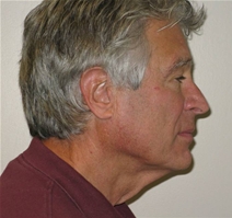 Facelift Before Photo by Neal Goldberg, MD; Scarsdale, NY - Case 22105