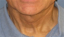 Facelift After Photo by Neal Goldberg, MD; Scarsdale, NY - Case 22105
