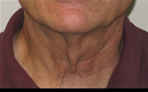 Facelift Before Photo by Neal Goldberg, MD; Scarsdale, NY - Case 22105