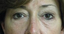 Dermal Fillers After Photo by Neal Goldberg, MD; Scarsdale, NY - Case 22287