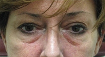 Dermal Fillers Before Photo by Neal Goldberg, MD; Scarsdale, NY - Case 22287