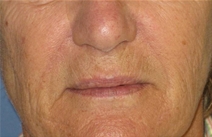 Dermal Fillers After Photo by Neal Goldberg, MD; Scarsdale, NY - Case 22288