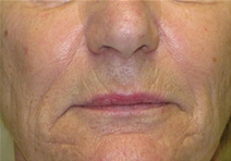 Dermal Fillers Before Photo by Neal Goldberg, MD; Scarsdale, NY - Case 22288