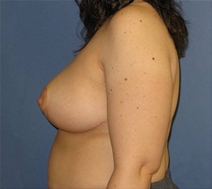 Breast Reduction After Photo by Neal Goldberg, MD; Scarsdale, NY - Case 22290