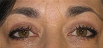 Eyelid Surgery After Photo by Neal Goldberg, MD; Scarsdale, NY - Case 22333