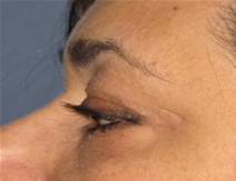 Eyelid Surgery Before Photo by Neal Goldberg, MD; Scarsdale, NY - Case 22333