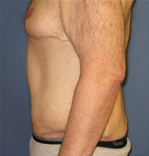 Body Contouring After Photo by Neal Goldberg, MD; Scarsdale, NY - Case 22334