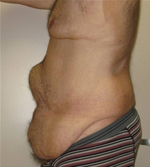 Body Contouring Before Photo by Neal Goldberg, MD; Scarsdale, NY - Case 22334