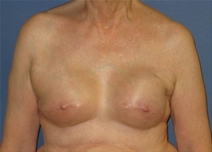 Breast Reconstruction After Photo by Neal Goldberg, MD; Scarsdale, NY - Case 22335