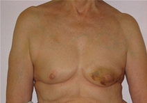 Breast Reconstruction Before Photo by Neal Goldberg, MD; Scarsdale, NY - Case 22335