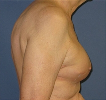 Breast Reconstruction After Photo by Neal Goldberg, MD; Scarsdale, NY - Case 22335