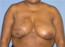 Breast Reconstruction After Photo by Neal Goldberg, MD; Scarsdale, NY - Case 22336