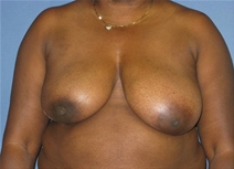 Breast Reconstruction Before Photo by Neal Goldberg, MD; Scarsdale, NY - Case 22336