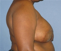 Breast Reconstruction After Photo by Neal Goldberg, MD; Scarsdale, NY - Case 22336