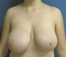 Breast Reduction Before Photo by Neal Goldberg, MD; Scarsdale, NY - Case 22337