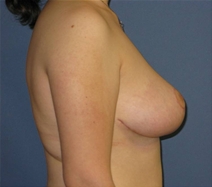 Breast Reduction After Photo by Neal Goldberg, MD; Scarsdale, NY - Case 22337