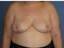 Breast Reduction After Photo by Neal Goldberg, MD; Scarsdale, NY - Case 22355