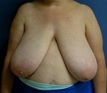 Breast Reduction Before Photo by Neal Goldberg, MD; Scarsdale, NY - Case 22355