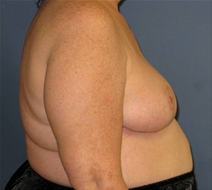 Breast Reduction After Photo by Neal Goldberg, MD; Scarsdale, NY - Case 22355