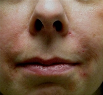 Dermal Fillers After Photo by Neal Goldberg, MD; Scarsdale, NY - Case 22356