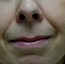 Dermal Fillers Before Photo by Neal Goldberg, MD; Scarsdale, NY - Case 22356