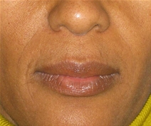 Dermal Fillers After Photo by Neal Goldberg, MD; Scarsdale, NY - Case 22486