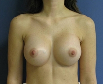 Breast Augmentation After Photo by Neal Goldberg, MD; Scarsdale, NY - Case 22498