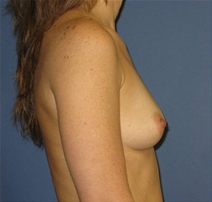 Breast Augmentation Before Photo by Neal Goldberg, MD; Scarsdale, NY - Case 22498