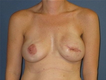 Breast Reconstruction After Photo by Neal Goldberg, MD; Scarsdale, NY - Case 22499