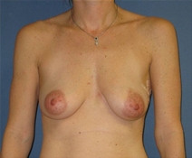 Breast Reconstruction Before Photo by Neal Goldberg, MD; Scarsdale, NY - Case 22499