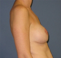 Breast Reconstruction After Photo by Neal Goldberg, MD; Scarsdale, NY - Case 22499