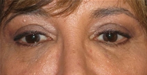 Dermal Fillers After Photo by Neal Goldberg, MD; Scarsdale, NY - Case 22503