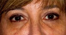 Dermal Fillers Before Photo by Neal Goldberg, MD; Scarsdale, NY - Case 22503