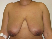 Breast Reconstruction Before Photo by Neal Goldberg, MD; Scarsdale, NY - Case 22556
