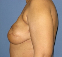Breast Reconstruction After Photo by Neal Goldberg, MD; Scarsdale, NY - Case 22556