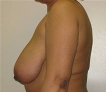 Breast Reconstruction Before Photo by Neal Goldberg, MD; Scarsdale, NY - Case 22556