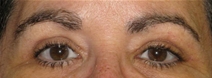 Eyelid Surgery After Photo by Neal Goldberg, MD; Scarsdale, NY - Case 22659