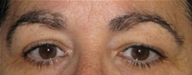 Eyelid Surgery Before Photo by Neal Goldberg, MD; Scarsdale, NY - Case 22659