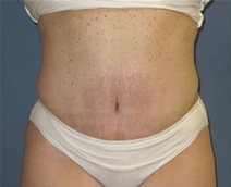 Tummy Tuck After Photo by Neal Goldberg, MD; Scarsdale, NY - Case 22666