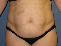 Tummy Tuck Before Photo by Neal Goldberg, MD; Scarsdale, NY - Case 22666