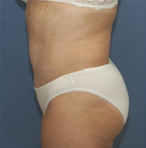 Tummy Tuck After Photo by Neal Goldberg, MD; Scarsdale, NY - Case 22666